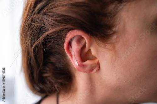 The girl's face and ear after otoplasty. Close-up. 3 days after the operation. Plastic