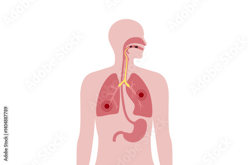 Aspiration pneumonia poster