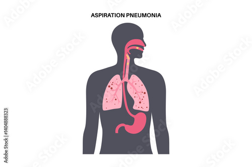 Aspiration pneumonia poster