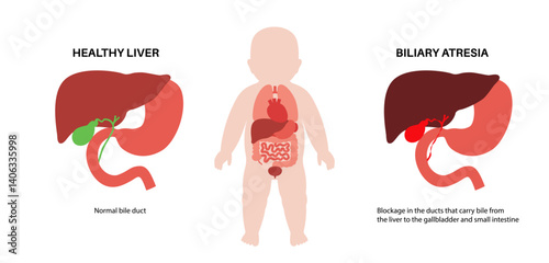 Biliary atresia disease