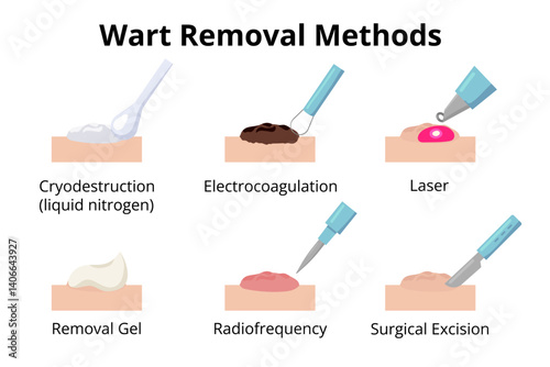 Wart removal methods showing cryodestruction, electrocoagulation, laser, removal gel, radiofrequency and surgical excision