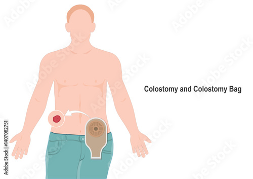 A colostomy is a surgical procedure that changes the trajectory of food waste.