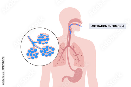 Aspiration pneumonia poster