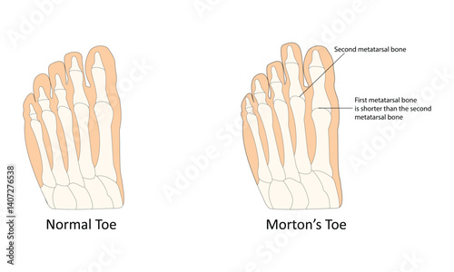 Morton's toe vector illustration