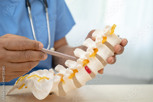 Doctor with lumbar vertebra bone skeleton and nerve model for treatment in the orthopedic department.