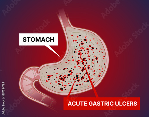 Unhealthy stomach. Acute gastric ulcers, gastritis. Gastroesophageal reflux disease. Peptic ulcer disease. Digestive system. Humans' anatomical structure. Medical illustration, vector illustration.