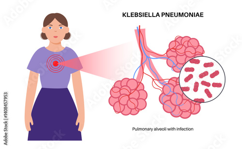 Klebsiella pneumoniae poster