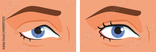 Eye Undergoing Blepharoplasty Surgery Vector Illustration. person undergoes a cosmetic procedure to remove upper eye excess skin 

