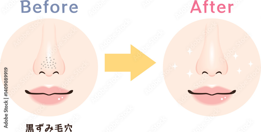 Fototapeta premium 鼻の毛穴トラブル ビフォーアフター|黒ずみ毛穴