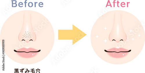 鼻の毛穴トラブル　ビフォーアフター｜黒ずみ毛穴