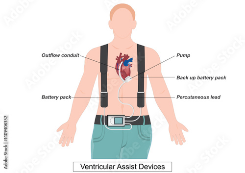 A ventricular assist device (VAD) is a device that helps pump blood.