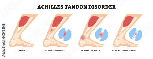 Different types of Achilles Tendon Disorder types, educational medical poster design healthcare scheme, labeled Healthy Tendon, Tendinosis, Tendinitis, and Tendon Rupture. Injury Feet calf test range.