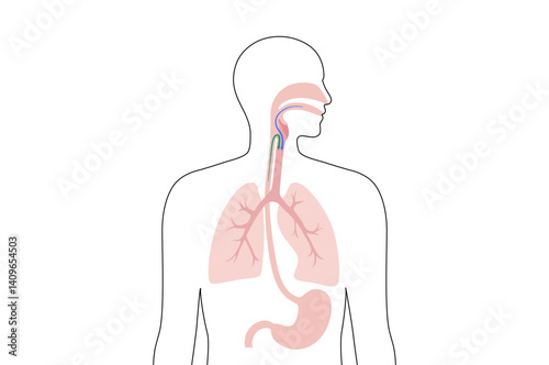 Aspiration pneumonia poster