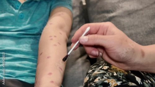 A child illness skin rash epidemic with vaccination indoors