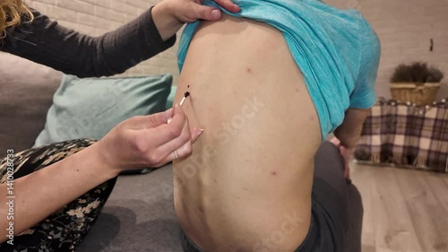 A child illness skin rash epidemic with vaccination indoors