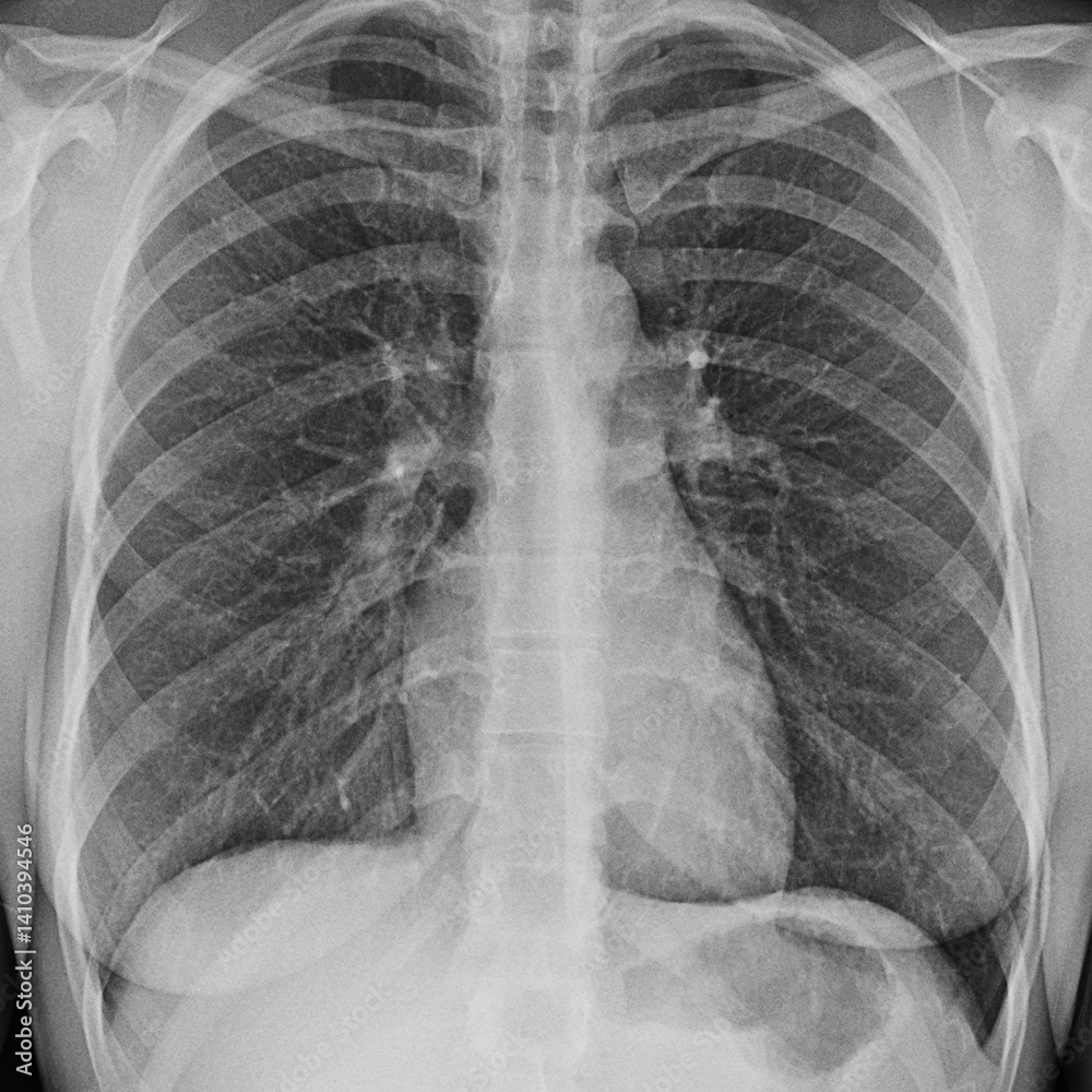 Real Chest X-Ray Scam Showing Ribcage and Lung Structure in Frontal view Real Chest X-Ray Scam Showing Ribcage and Lung Structure in Frontal view
