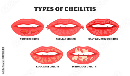 Different types of cheilitis types, educational medical poster design healthcare scheme, labeled Chronic angular cheilitis mouth oral disease. Actinic, angular, granulomatous, exfoliative, eczematous.