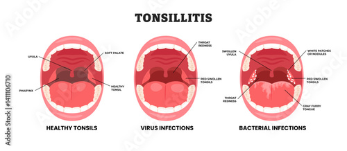 Different types of tonsillitis types, educational medical poster design healthcare scheme, labeled tonsillitis bacterial and viral.Angina, pharyngitis and tonsillitis. Infection of tonsils. Open mouth