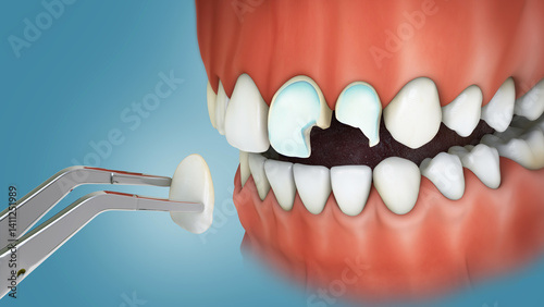 фотографія Dental veneers placement over frontal tooth