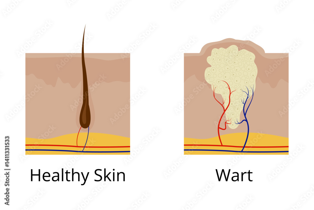 Obraz premium Healthy skin and wart comparison showing arteries and veins
