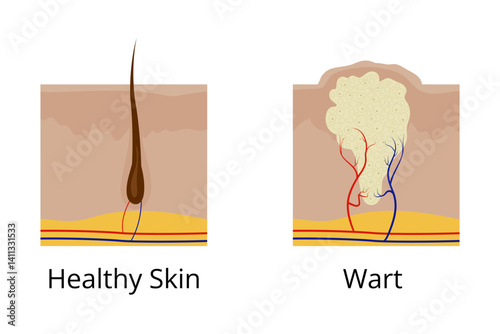 Healthy skin and wart comparison showing arteries and veins