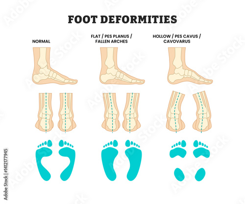 Different types of foot deformities types, educational medical poster design healthcare Orthopedic, Flatfoot (Pes Planus), High Arch (Pes Cavus), and Normal Foot Comparison Skeleton and Footprint.
