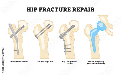 Different types of hip fracture repair types, educational medical poster design healthcare scheme, labeled intramedullary nail, parallel implant, hip compression screw, hemiarthroplasty. Bone Fracture