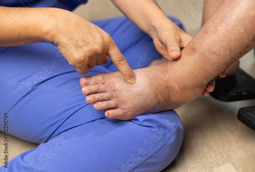 Elderly woman has edema or swelling foot.