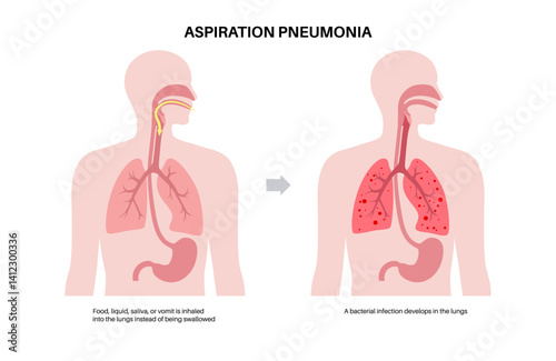 Aspiration pneumonia poster