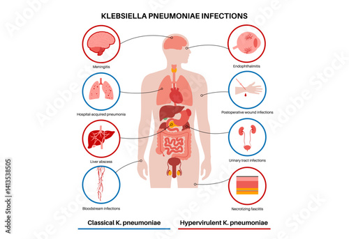 Klebsiella pneumoniae poster