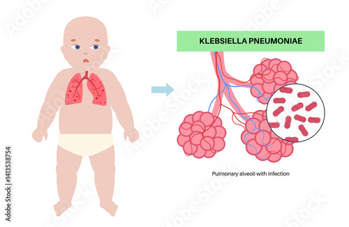 Klebsiella pneumoniae poster