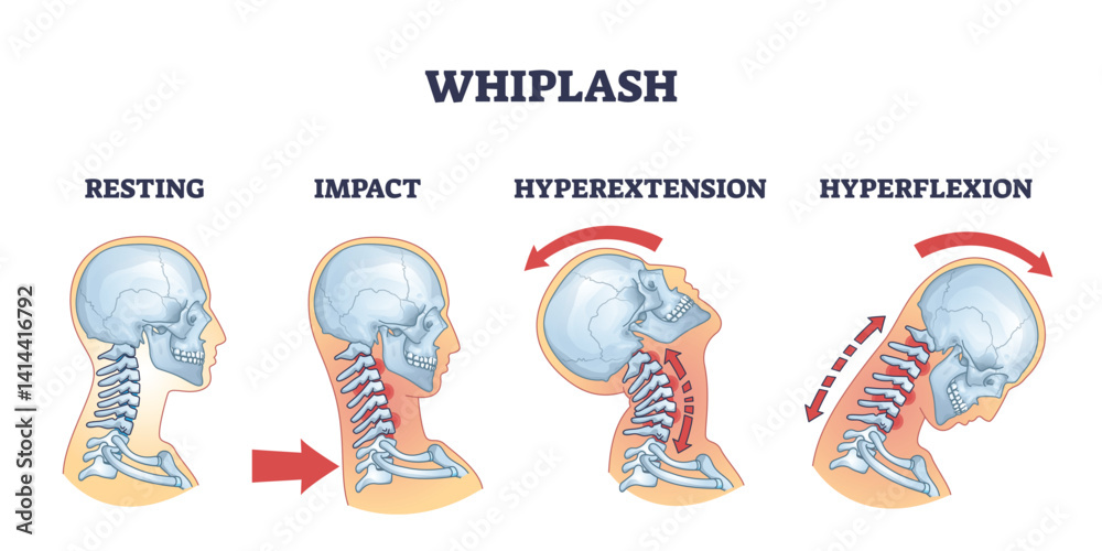 Ταπετσαρία Whiplash diagram shows neck movement stages, resting, impact, hyperextension, hyperflexion