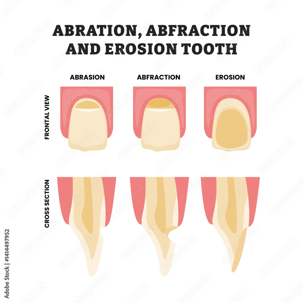 Φωτογραφία Different types of abrasion, abfraction and erosion tooth, educational medical poster design healthcare scheme, labeled with front and cross section view