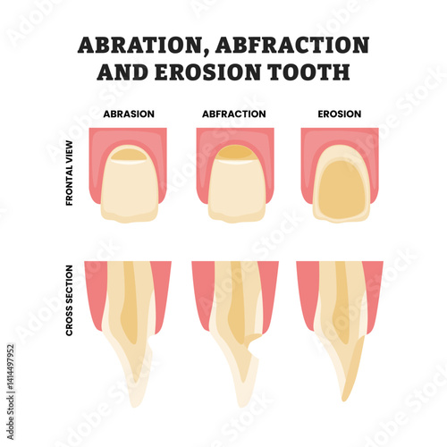 Different types of abrasion, abfraction and erosion tooth, educational medical poster design healthcare scheme, labeled with front and cross section view. Dental care treatment. Tooth Abscess.