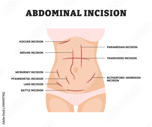 Abdominal Incision for woman, educational medical poster design healthcare scheme, labeled Surgical Cut in Abdomen for Medical Procedure, Anatomy, Laparotomy, Surgery Education