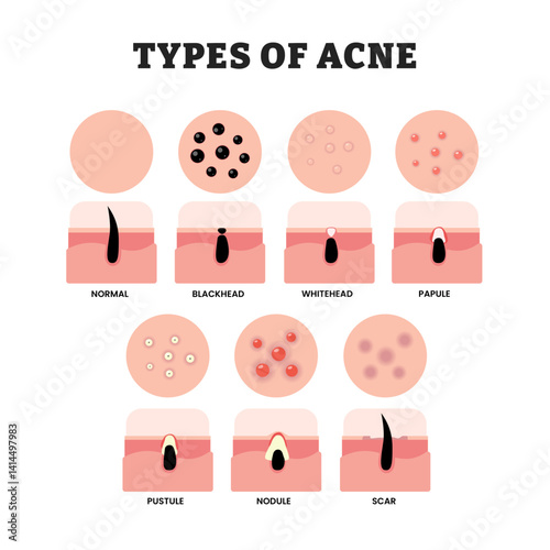 Different types of acne types, educational medical poster design healthcare scheme, labeled normal or healthy, blackhead, whitehead, papule, pustule, nodule, scar. Beauty skin problem disease.