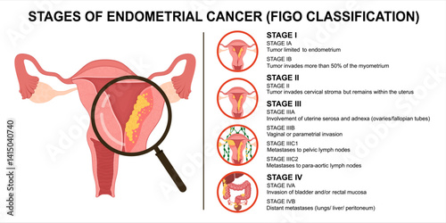Endometrial cancer stages. FIGO classification of uterine cancer	
