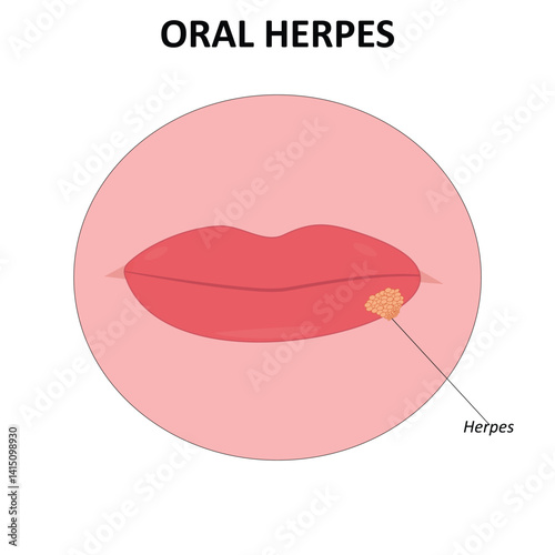 Oral herpes vector illustration