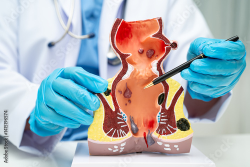 Fotografia Asian doctor with rectum and hemorrhoid human anatomy model at hospital, inflamed vascular structure