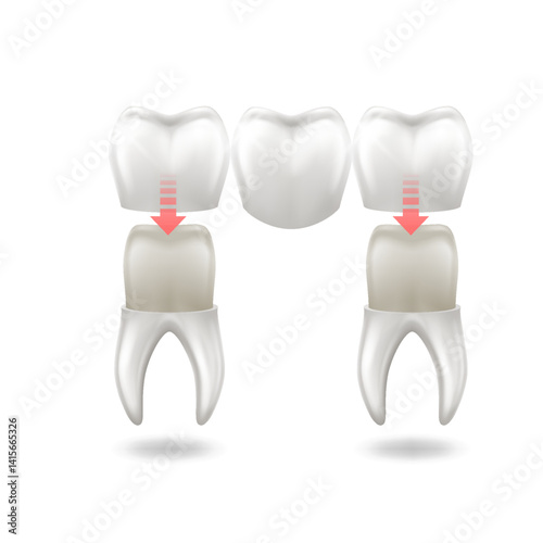 Dental procedure illustration showing crowns placed over teeth with arrows, enhancing patient understanding, on white background with copy space. Ideal for dental education materials.