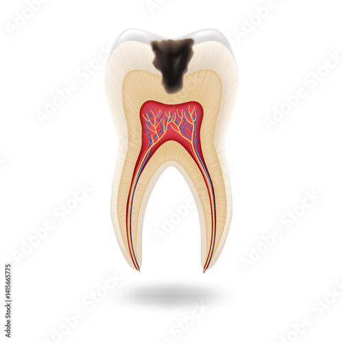 Detailed illustration of tooth anatomy showing decay in realistic style. Colors emphasize pulp and dentin with visual focus on decay. Educational tool for dentistry studies with copy space.
