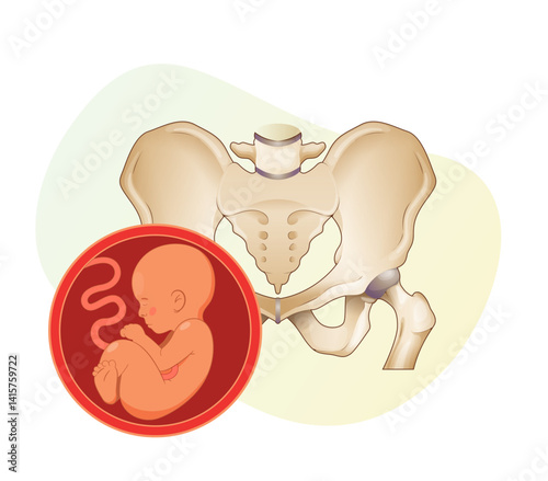 Pregnancy challenges with Cephalopelvic Disproportion - Stock Illustration