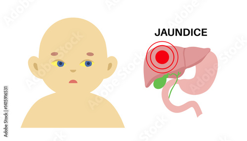 Jaundice yellow skin