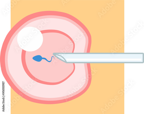 IVF ICSI vector illustration with orange square background. Perfect for presenting anything about reproduction.