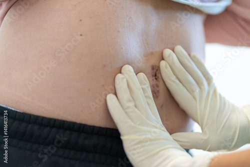 Healthcare worker in gloves closely inspects healing incision on patient's back, assessing wound recovery progress