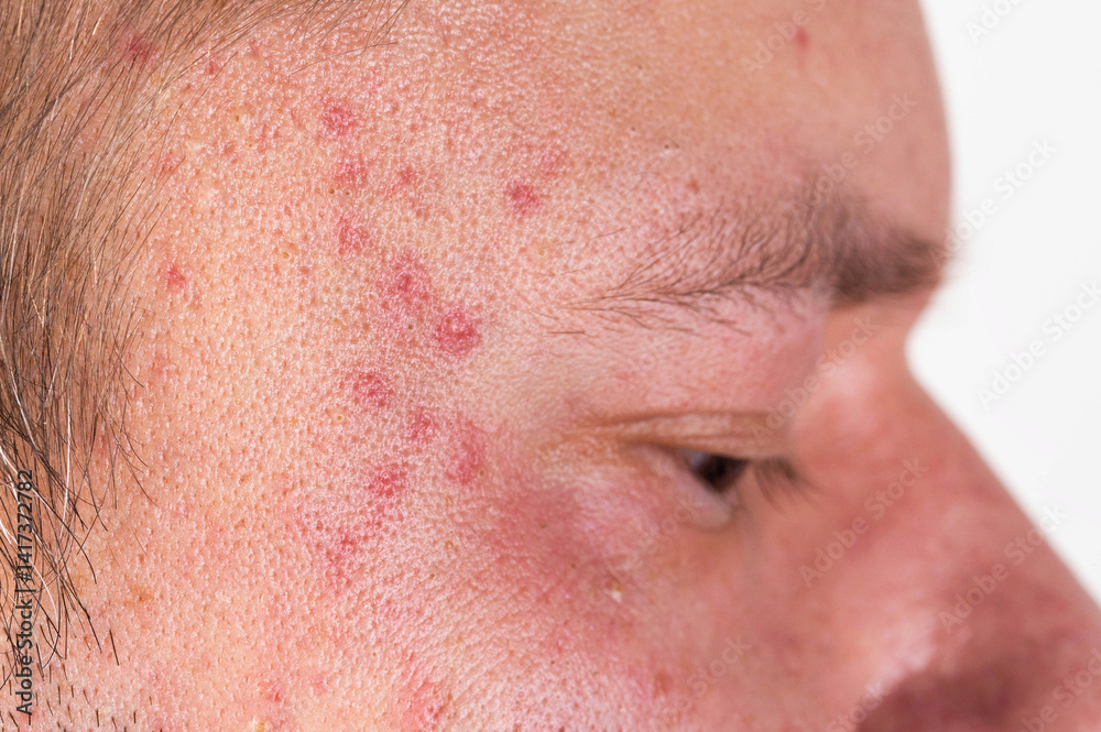 Naklejka premium Red spots and rashes on the scalp and eyes. Alcohol intolerance, alcoholic urticaria, allergies, close-up