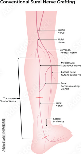 Conventional Sural Nerve Grafting Anatomy and Surgical Approach