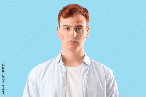 Teenage boy with acne on bl...