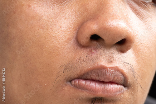 A young man is bothered by a large pimple on his face.