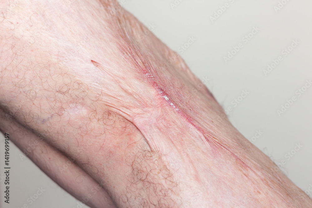 Fototapeta premium Close-up of the leg of an adult Caucasian man with a big keloid scar on the skin of his leg after a burn.
